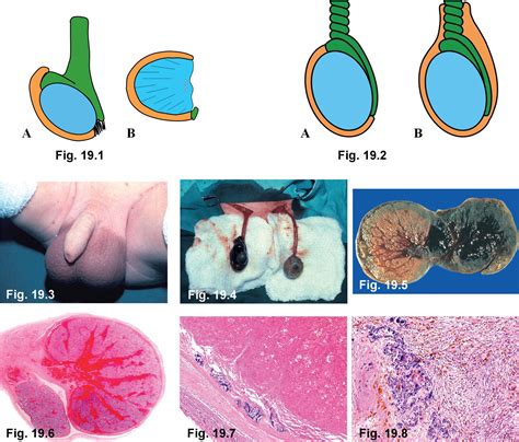 testicular torsion after treatment